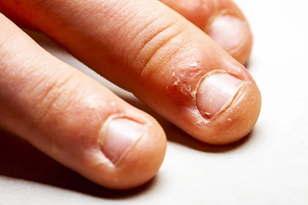 Close-up van de hand met gebeten vinger en nagels. — Stockfoto