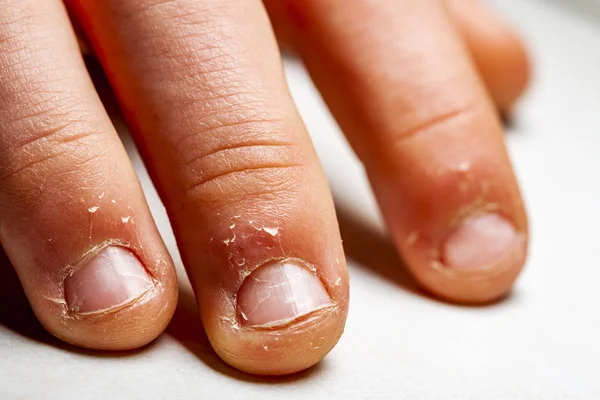 Primer plano de la mano con el dedo mordido y las uñas . —  Fotos de Stock