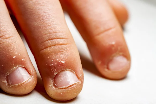 Close up of hand with bitten finger and fingernails. — Stock Photo, Image