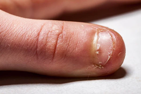 Close Van Hand Met Gebeten Vinger Nagels — Stockfoto