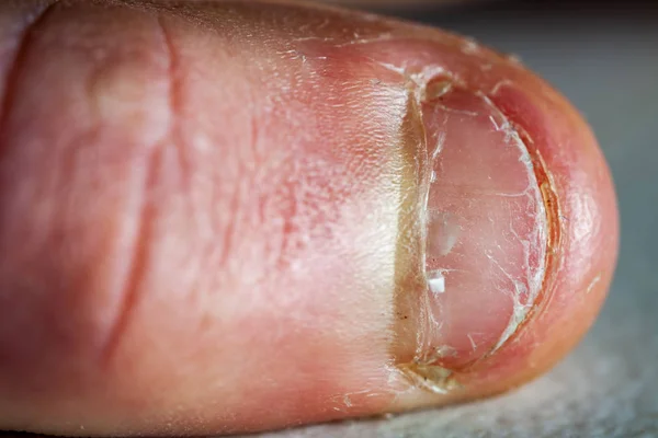 Close-up van de hand met gebeten vinger en nagels. — Stockfoto
