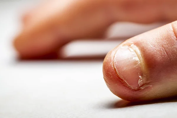 Close up of hand with bitten finger and fingernails.