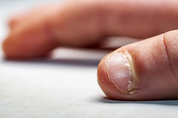 Primer plano de la mano con el dedo mordido y las uñas . —  Fotos de Stock