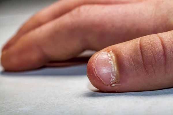 Primer plano de la mano con el dedo mordido y las uñas . —  Fotos de Stock