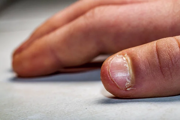 Primo piano della mano con dito morso e unghie . — Foto Stock