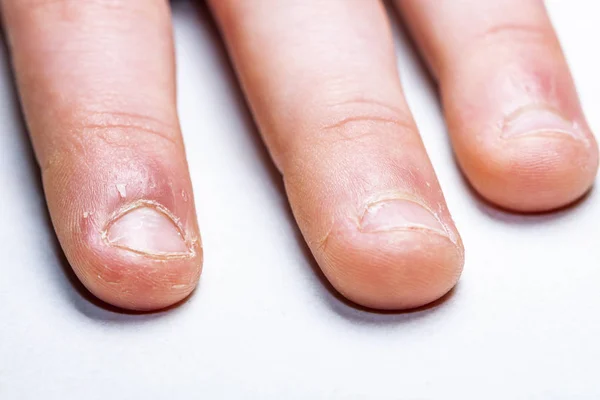 Primer plano de la mano con el dedo mordido y las uñas . —  Fotos de Stock
