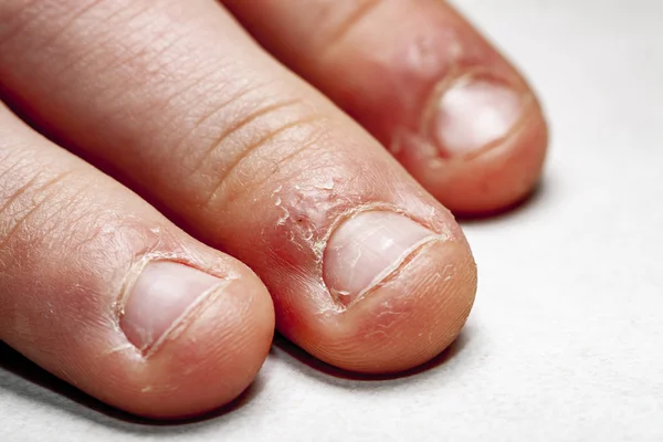 Close-up van de hand met gebeten vinger en nagels. — Stockfoto