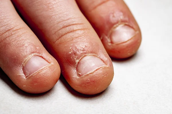 Close-up van de hand met gebeten vinger en nagels. — Stockfoto