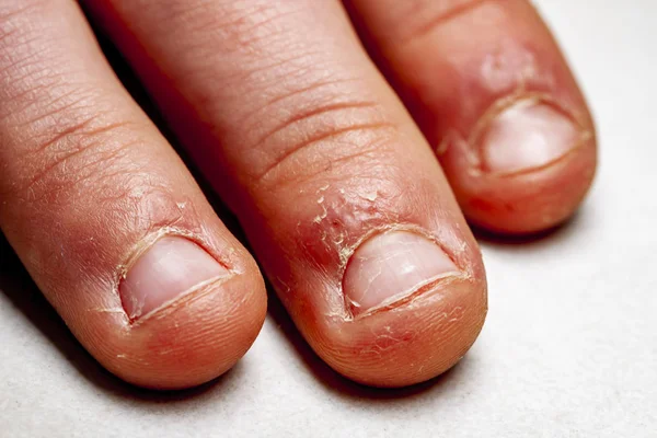 Primer plano de la mano con el dedo mordido y las uñas . —  Fotos de Stock