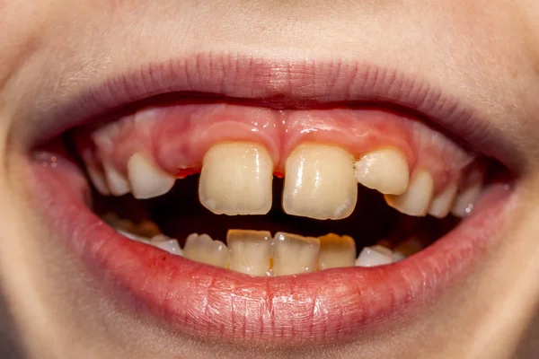 ミルクの歯の手術を削除した後彼の赤ちゃんの歯を失うことはない - 永続的な赤ちゃんの歯の治療後 10 ヶ月の問題で 8 歳の子供のクローズ アップとも呼ばれますサメ病- — ストック写真