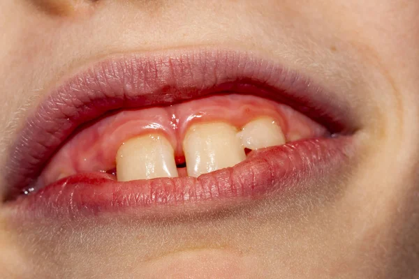 ミルクの歯の手術を削除した後彼の赤ちゃんの歯を失うことはない - 永続的な赤ちゃんの歯の治療後 10 ヶ月の問題で 8 歳の子供のクローズ アップとも呼ばれますサメ病- — ストック写真