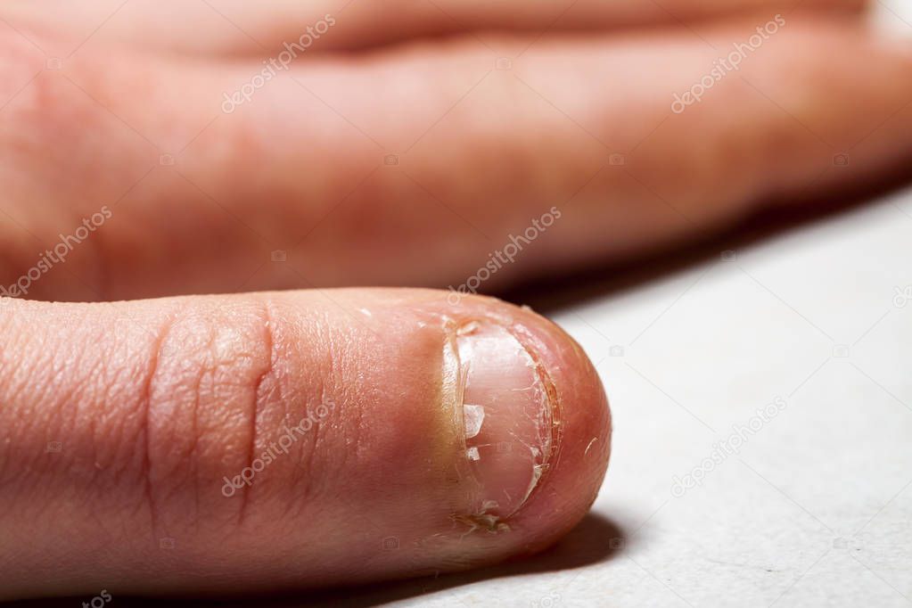 Close up of hand with bitten finger and fingernails.