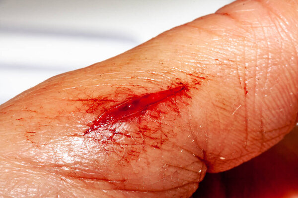 One photo of a series of photos taken of a fresh bleeding cut development over a priod of 90 minutes