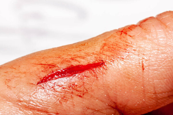 One photo of a series of photos taken of a fresh bleeding cut development over a priod of 90 minutes