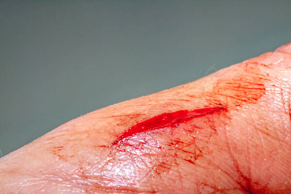 One photo of a series of photos taken of a fresh bleeding cut development over a priod of 90 minutes