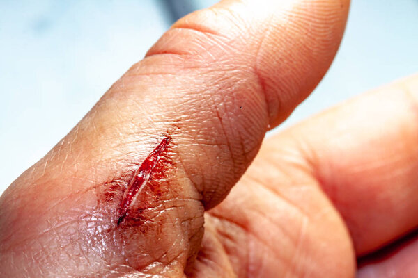 One photo of a series of photos taken of a fresh bleeding cut development over a priod of 90 minutes