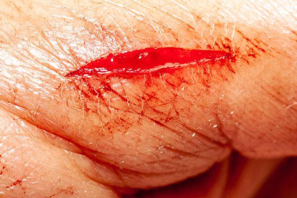 One photo of a series of photos taken of a fresh bleeding cut development over a priod of 90 minutes