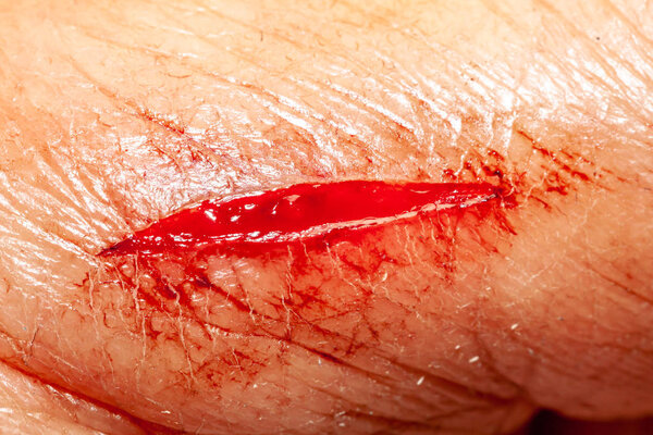 One photo of a series of photos taken of a fresh bleeding cut development over a priod of 90 minutes