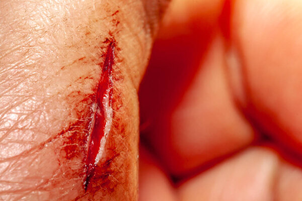 Одна фотография серии фотографий, сделанных со свежим кровоточащим разрезом за 90 минут
