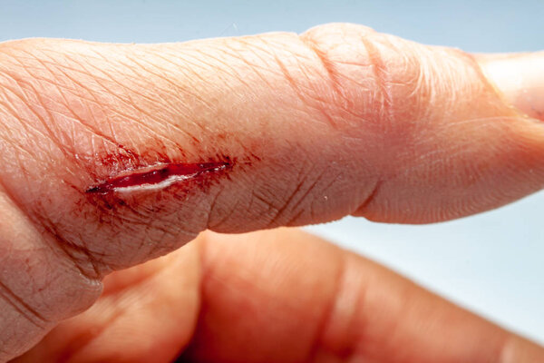 One photo of a series of photos taken of a fresh bleeding cut development over a priod of 90 minutes