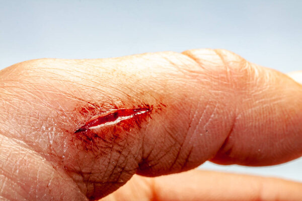 One photo of a series of photos taken of a fresh bleeding cut development over a priod of 90 minutes