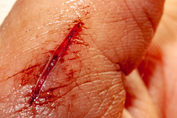 One photo of a series of photos taken of a fresh bleeding cut development over a priod of 90 minutes