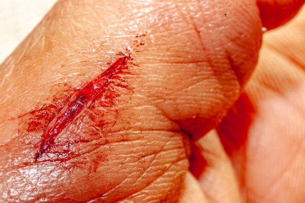 One photo of a series of photos taken of a fresh bleeding cut development over a priod of 90 minutes