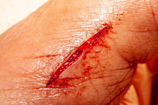 One photo of a series of photos taken of a fresh bleeding cut development over a priod of 90 minutes