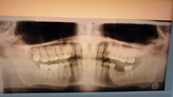 Filmagem de raio-X filme de 360 graus de dentes e mandíbula — Vídeo de Stock