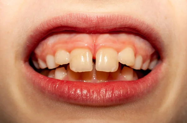 Branco europeu escola menino mostrando seu projetando superior frente dentes — Fotografia de Stock