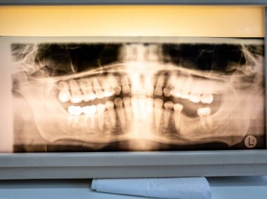 Orta yaşlı adamın panoramik diş X-Ray fotoğrafı