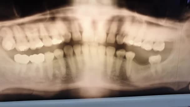 Panoráma Fogászati röntgen fénykép a középkorú férfi csökkent villogás hatása a kijelzőn — Stock videók
