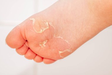 After the red rash and the strawberry tongue caused by scarlet fever the affected skin often peels - Here Skin of foot peeling clipart