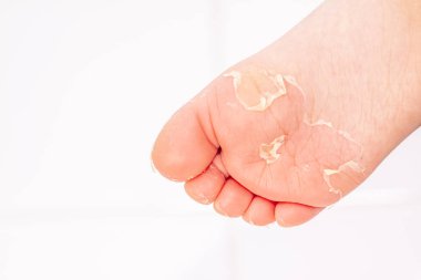 Kırmızı döküntü ve kızıl ateş neden çilek dili sonra etkilenen cilt genellikle peeling-burada ayak soyma cilt