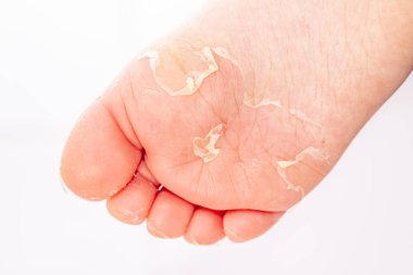 Kırmızı döküntü ve kızıl ateş neden çilek dili sonra etkilenen cilt genellikle peeling-burada ayak soyma cilt