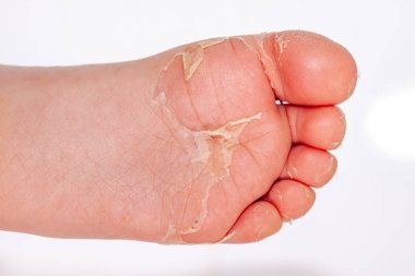 Kırmızı döküntü ve kızıl ateş neden çilek dili sonra etkilenen cilt genellikle peeling-burada ayak soyma cilt