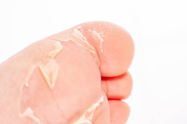 Kırmızı döküntü ve kızıl ateş neden çilek dili sonra etkilenen cilt genellikle peeling-burada ayak soyma cilt