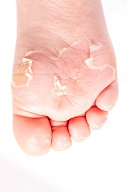 Kırmızı döküntü ve kızıl ateş neden çilek dili sonra etkilenen cilt genellikle peeling-burada ayak soyma cilt