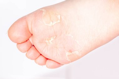 Kırmızı döküntü ve kızıl ateş neden çilek dili sonra etkilenen cilt genellikle peeling-burada ayak soyma cilt