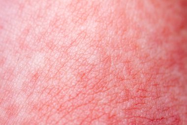 Scarlet Fever kırmızı acele ve çilek dili ile başlar daha sonra etkilenen cilt genellikle peeling-burada kırmızı cilt acele