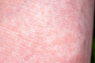 Scarlet Fever kırmızı acele ve çilek dili ile başlar daha sonra etkilenen cilt genellikle peeling-burada kırmızı cilt acele