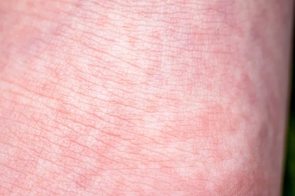 La fiebre escarlata comienza con una fiebre roja y la lengua de fresa Después de que la piel afectada a menudo se pela - Aquí la fiebre de la piel roja — Foto de Stock