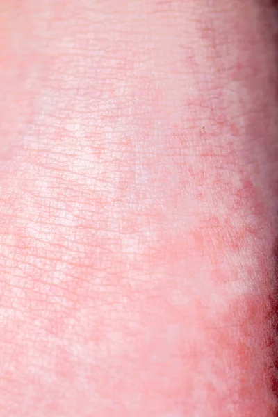 Η οστρακιά ξεκινά με μια κόκκινη βιασύνη και τη γλώσσα της φράουλας μετά το προσβεβλημένο δέρμα συχνά ξεφλουδίζει-εδώ κόκκινο βιασύνη του δέρματος — Φωτογραφία Αρχείου