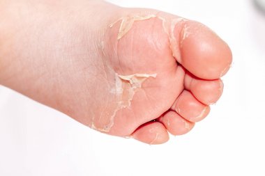 Kırmızı döküntü ve kızıl ateş neden çilek dili sonra etkilenen cilt genellikle peeling-burada ayak soyma cilt