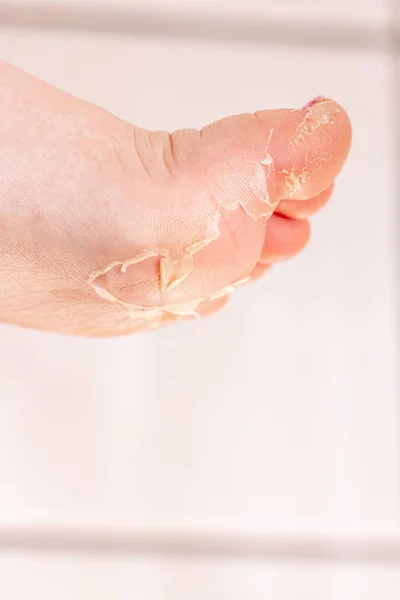 Efter den röda utslag och jordgubbs tungan orsakad av scharlakansfeber den drabbade huden ofta peeling-här huden på foten peeling — Stockfoto