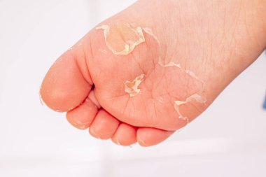 Kırmızı döküntü ve kızıl ateş neden çilek dili sonra etkilenen cilt genellikle peeling-burada ayak soyma cilt