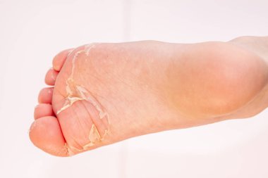 Kırmızı döküntü ve kızıl ateş neden çilek dili sonra etkilenen cilt genellikle peeling-burada ayak soyma cilt