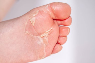 Kırmızı döküntü ve kızıl ateş neden çilek dili sonra etkilenen cilt genellikle peeling-burada ayak soyma cilt