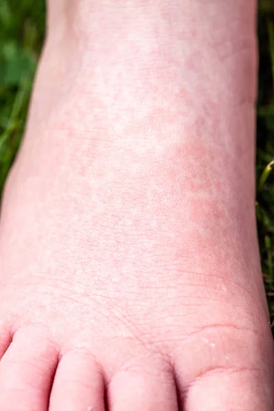 Febre Escarlate começa com uma correria vermelha e a língua de morango Depois a pele afetada muitas vezes descasca - Aqui a correria da pele vermelha — Fotografia de Stock