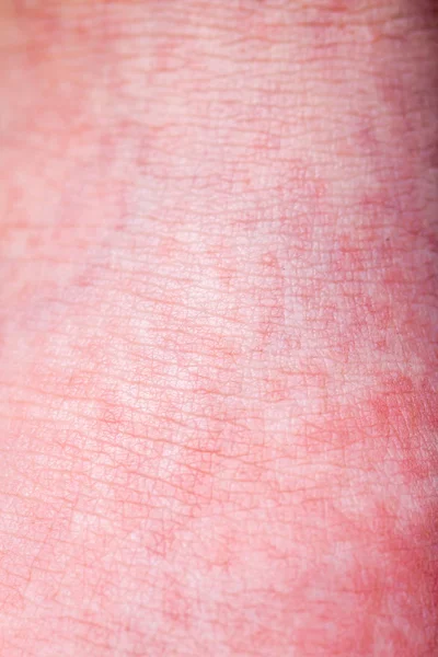 La fiebre escarlata comienza con una fiebre roja y la lengua de fresa Después de que la piel afectada a menudo se pela - Aquí la fiebre de la piel roja — Foto de Stock